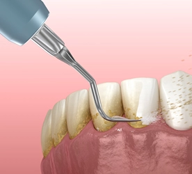 Dental Scaling Cleaning and Polishing